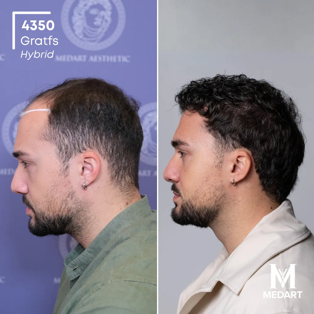 Andrea Petrecca Hybride haartransplantatie voor-en-na-foto 4, 4350 grafts bij Medart Hair
