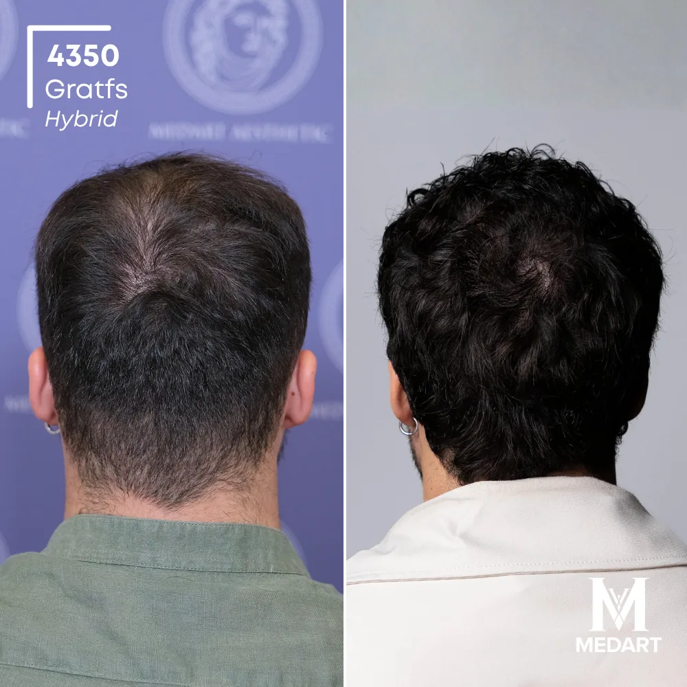 Andrea Petrecca Hybride haartransplantatie voor-en-na-foto 5, 4350 grafts bij Medart Hair