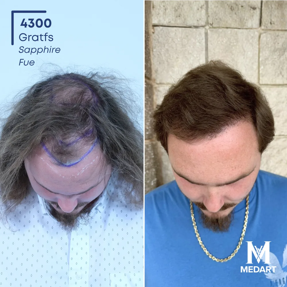 Benjamin Whitaker Sapphire FUE-haartransplantatie voor-en-na-foto 2, 4300 grafts bij Medart Hair