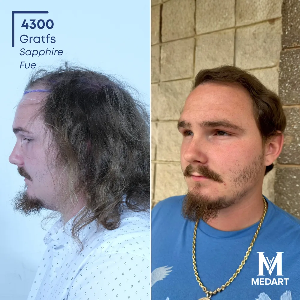 Benjamin Whitaker Sapphire FUE-haartransplantatie voor-en-na-foto 3, 4300 grafts bij Medart Hair