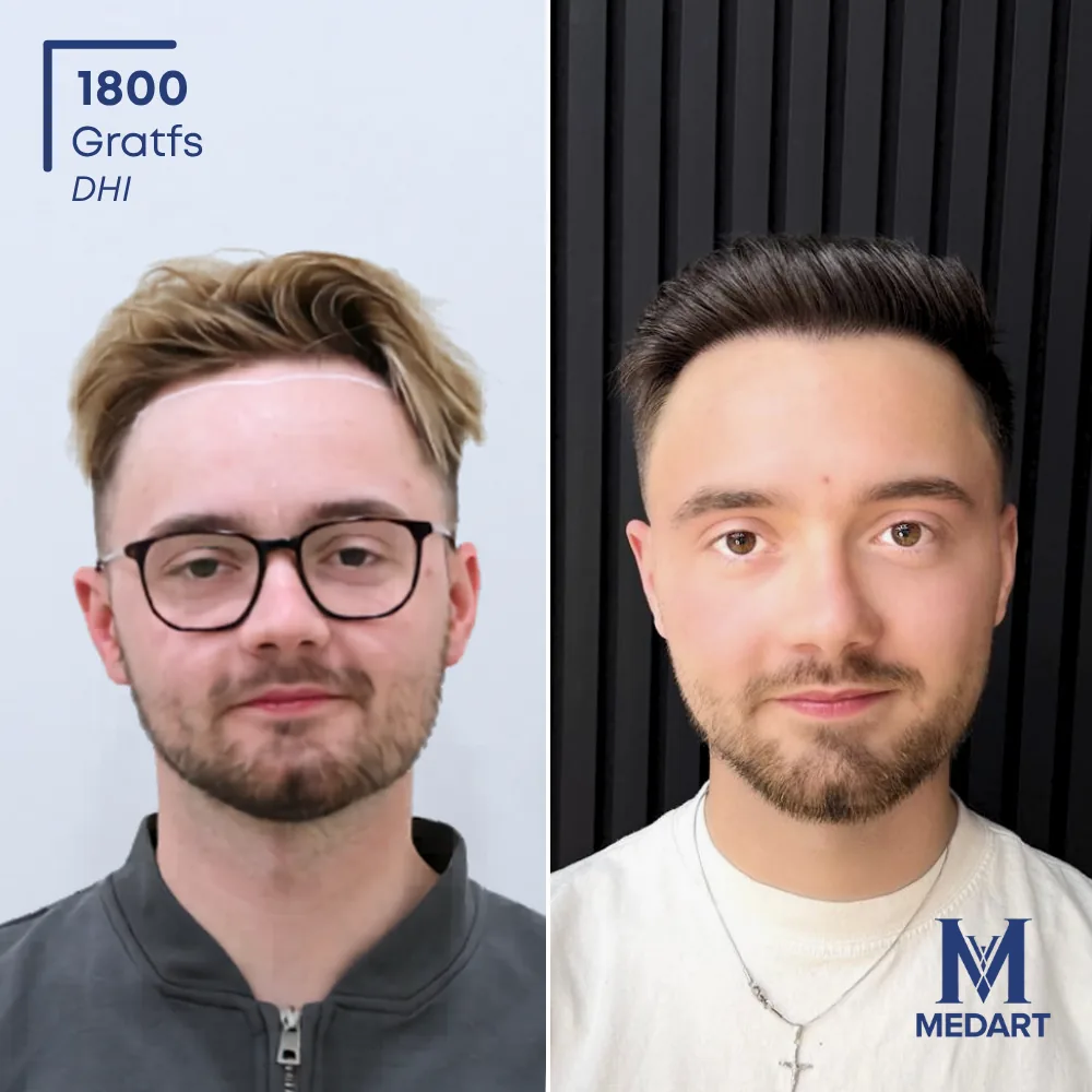 Vorher-Nachher-Foto 1 der DHI-Haartransplantation von Brandon Reilly, 1800 Grafts bei Medart Hair