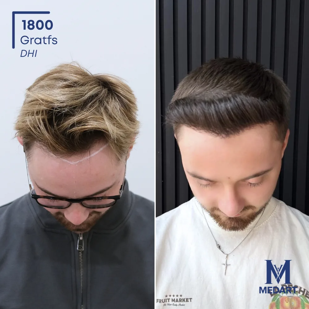 Vorher-Nachher-Foto 2 der DHI-Haartransplantation von Brandon Reilly, 1800 Grafts bei Medart Hair