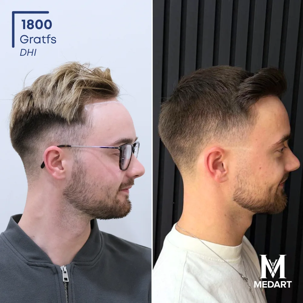 Vorher-Nachher-Foto 3 der DHI-Haartransplantation von Brandon Reilly, 1800 Grafts bei Medart Hair