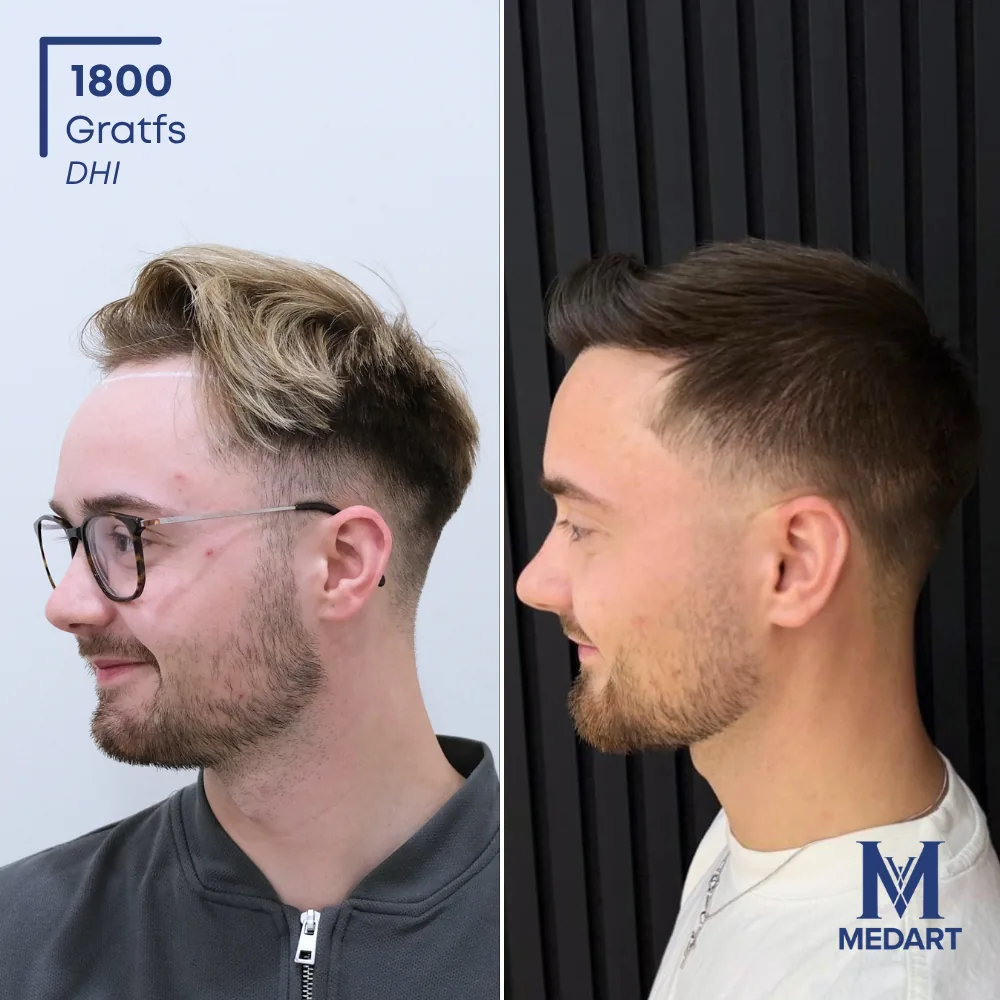 Vorher-Nachher-Foto 4 der DHI-Haartransplantation von Brandon Reilly, 1800 Grafts bei Medart Hair