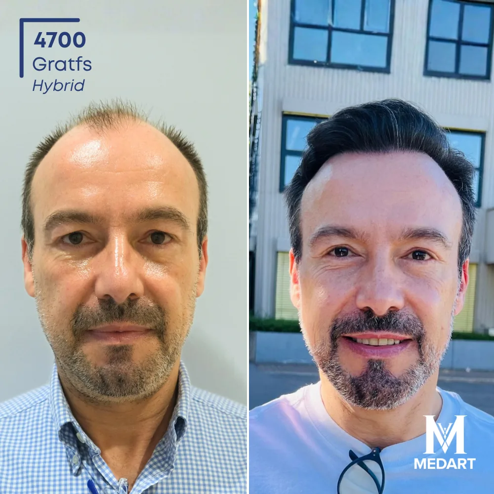 Carlos Vogel Hybride haartransplantatie voor-en-na-foto 1, 4700 grafts bij Medart Hair