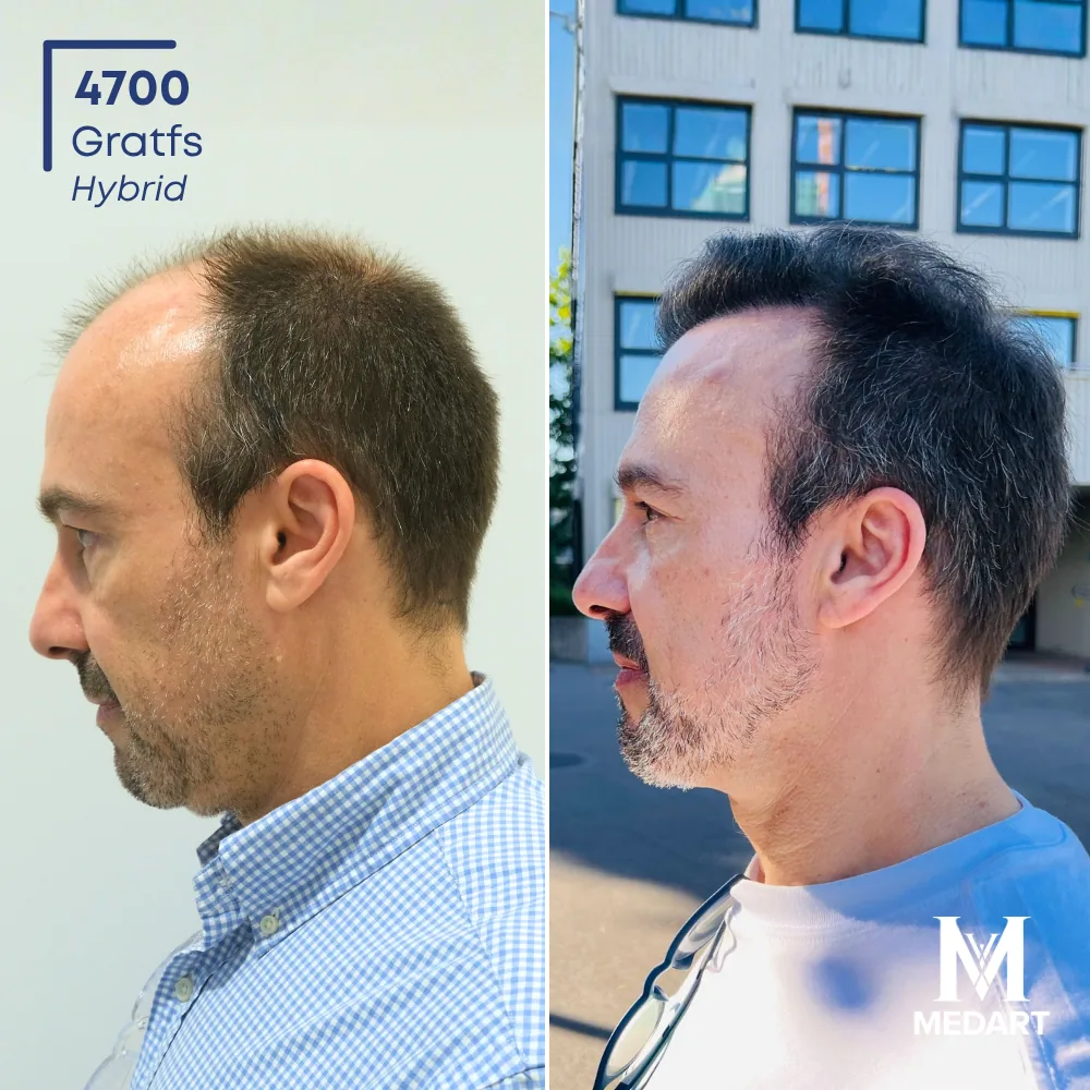 Carlos Vogel Hybride haartransplantatie voor-en-na-foto 2, 4700 grafts bij Medart Hair