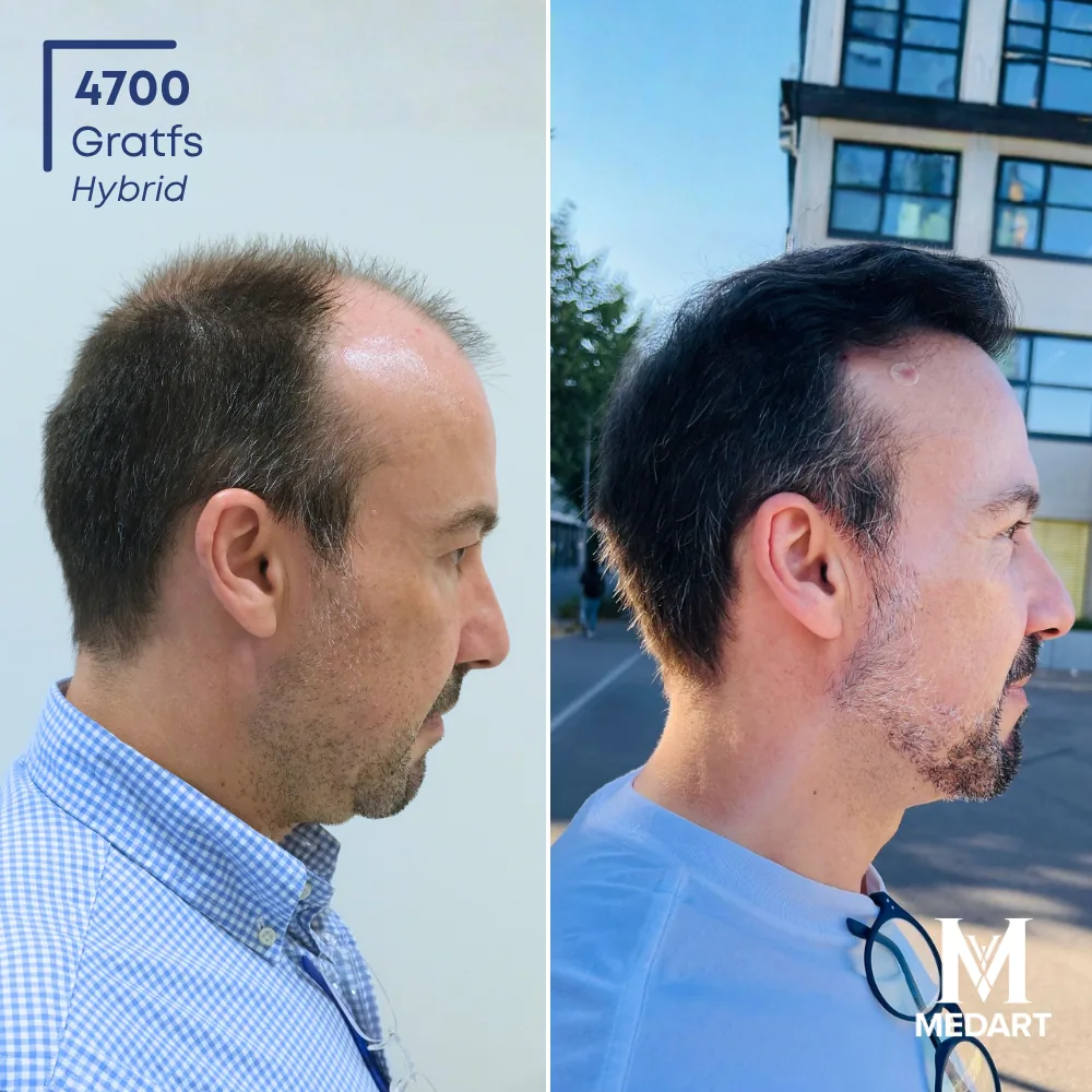 Carlos Vogel Hybride haartransplantatie voor-en-na-foto 3, 4700 grafts bij Medart Hair