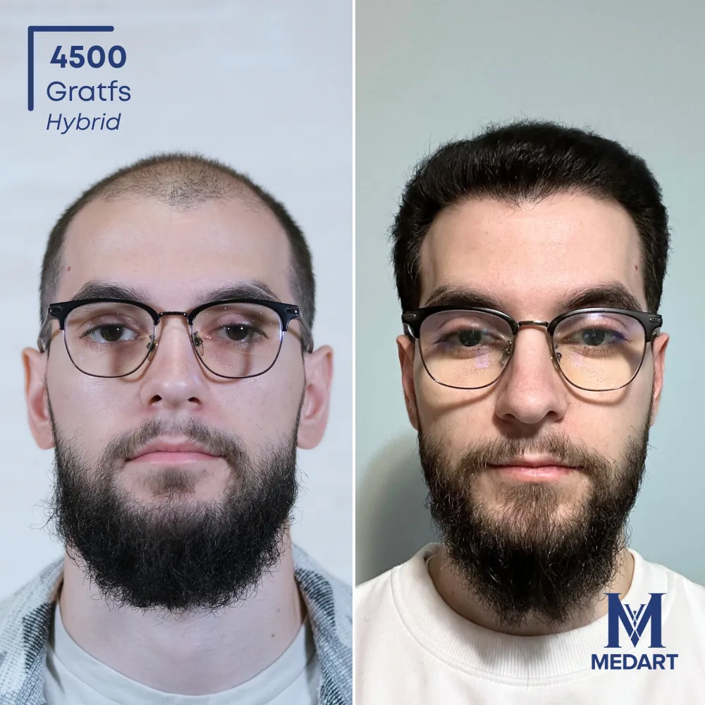Daniel Hybride haartransplantatie voor-en-na-foto 1, 4500 grafts bij Medart Hair