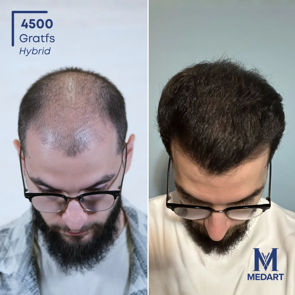 Daniel Hybride haartransplantatie voor-en-na-foto 2, 4500 grafts bij Medart Hair