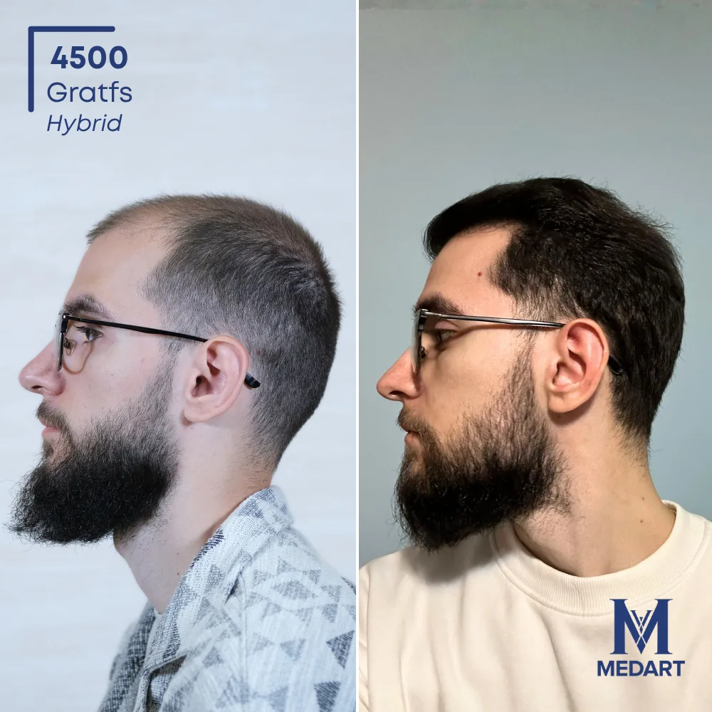 Daniel Hybride haartransplantatie voor-en-na-foto 3, 4500 grafts bij Medart Hair