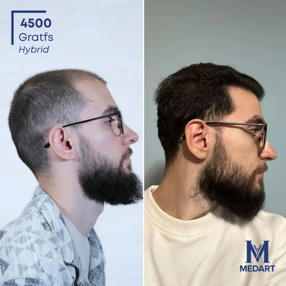 Daniel Hybride haartransplantatie voor-en-na-foto 4, 4500 grafts bij Medart Hair