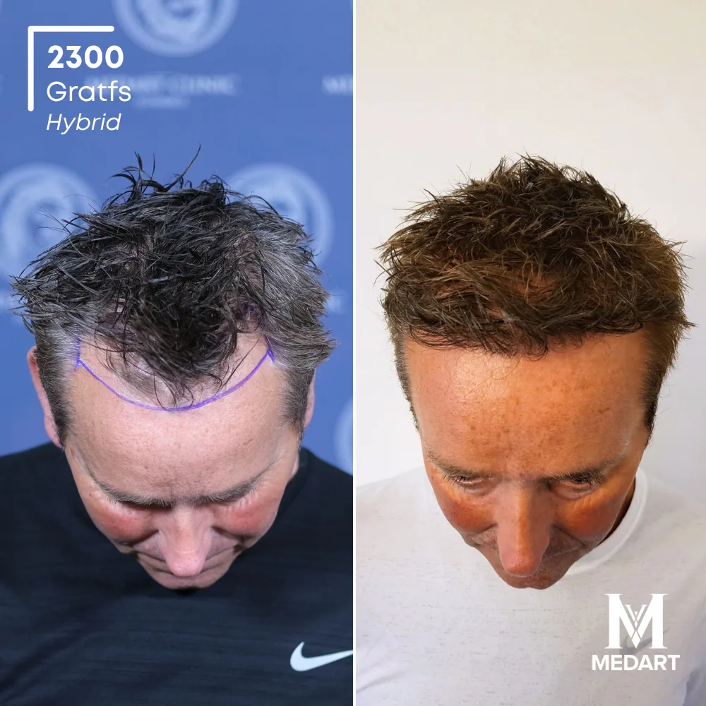 David Carter Hybride haartransplantatie voor-en-na-foto 4, 2300 grafts bij Medart Hair