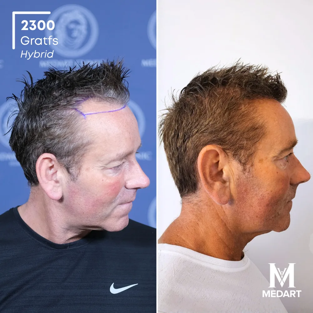 David Carter Hybride haartransplantatie voor-en-na-foto 2, 2300 grafts bij Medart Hair