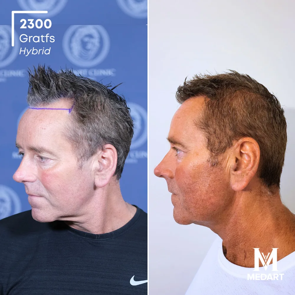 David Carter Hybride haartransplantatie voor-en-na-foto 3, 2300 grafts bij Medart Hair