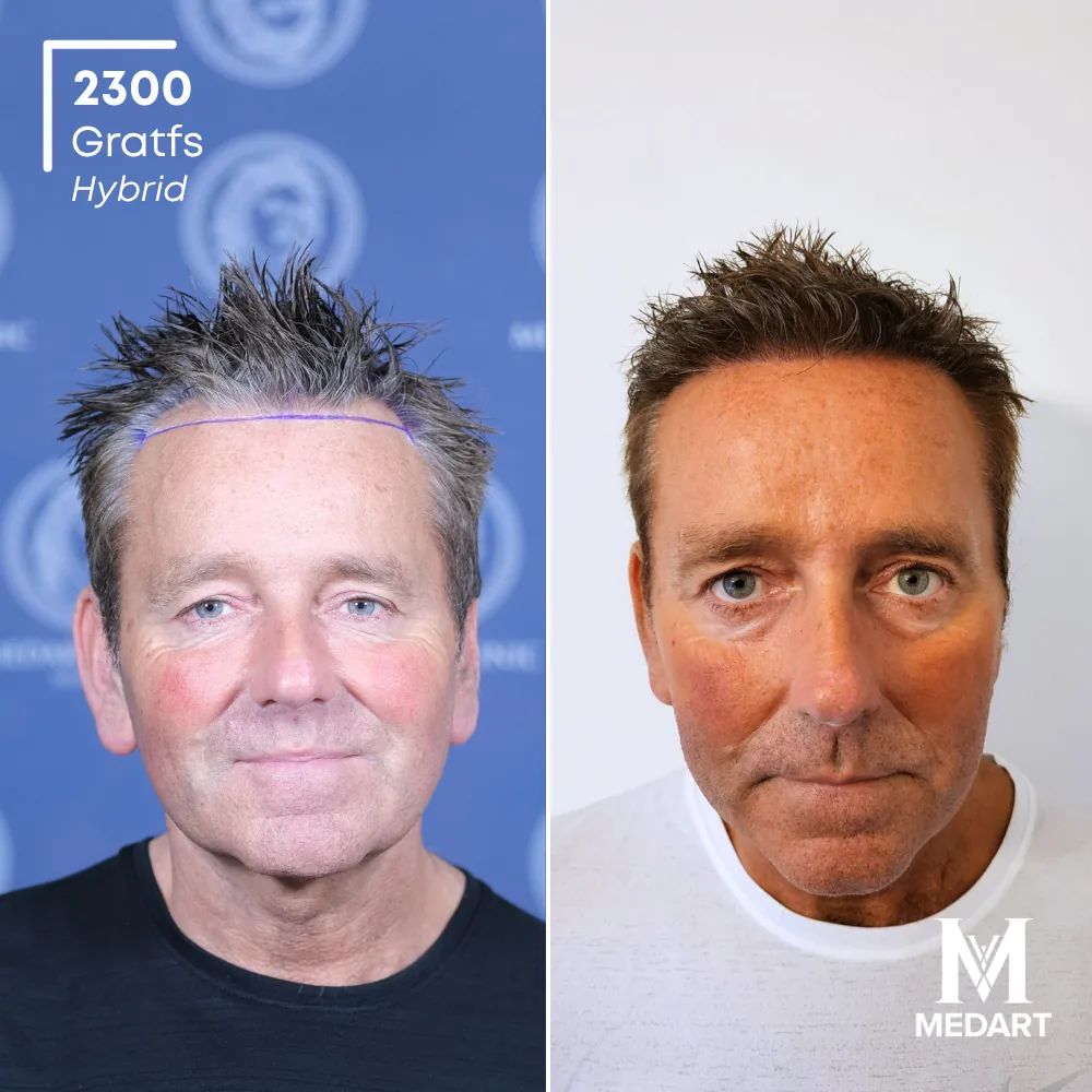 David Carter Hybride haartransplantatie voor-en-na-foto 1, 2300 grafts bij Medart Hair