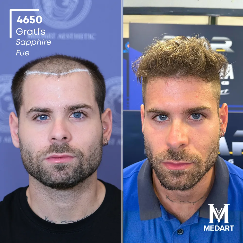 Delbianco Sapphire FUE-haartransplantatie voor-en-na-foto 1, 4650 grafts bij Medart Hair