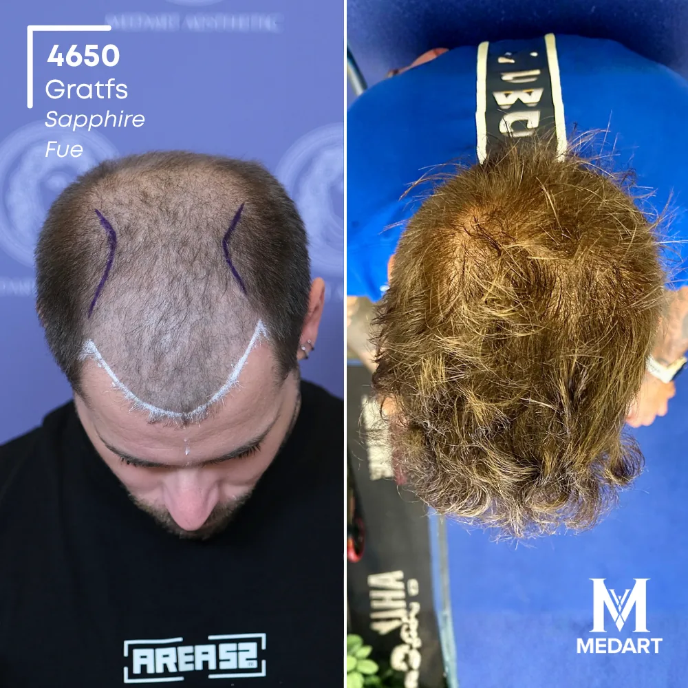 Delbianco Sapphire FUE-haartransplantatie voor-en-na-foto 2, 4650 grafts bij Medart Hair