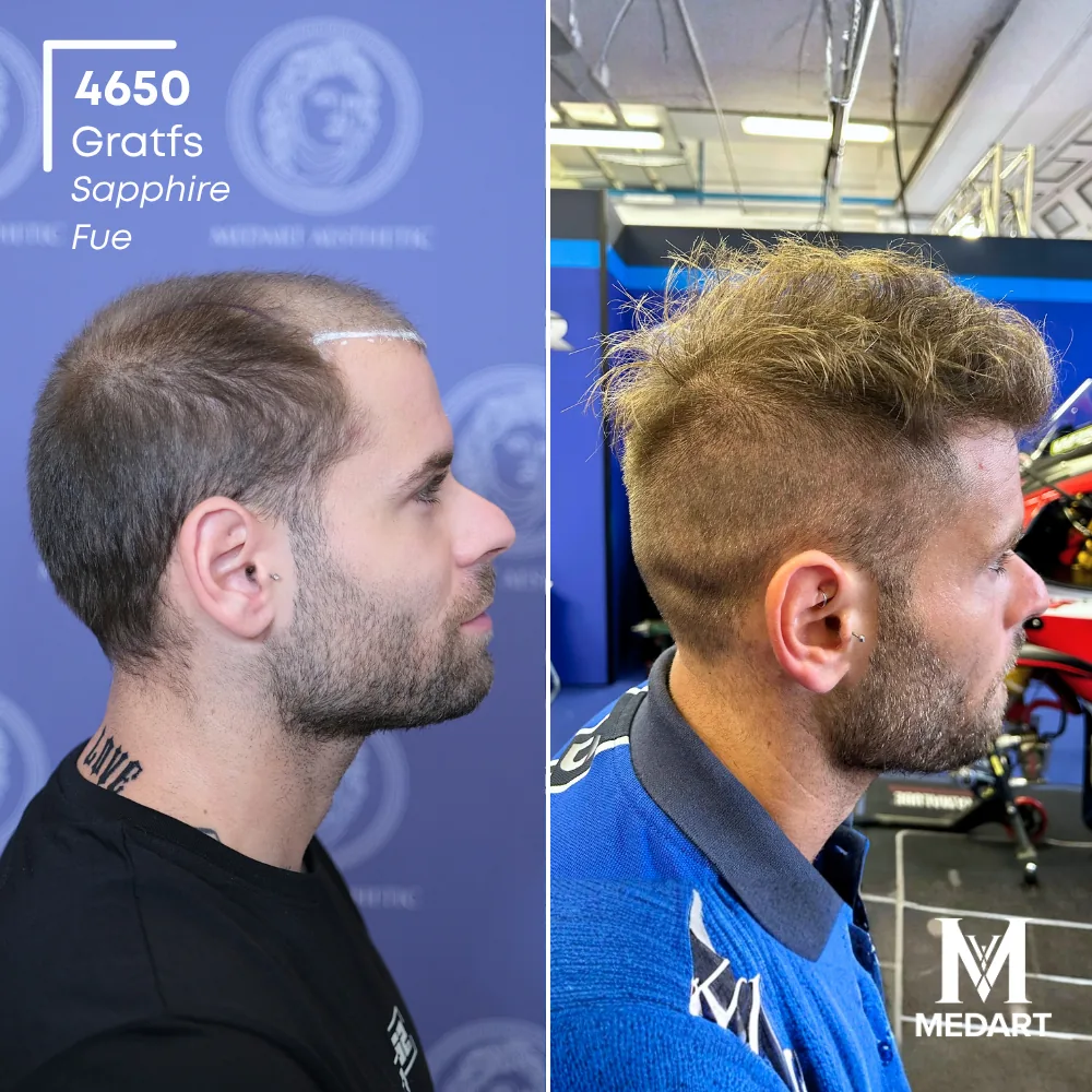 Delbianco Sapphire FUE-haartransplantatie voor-en-na-foto 3, 4650 grafts bij Medart Hair