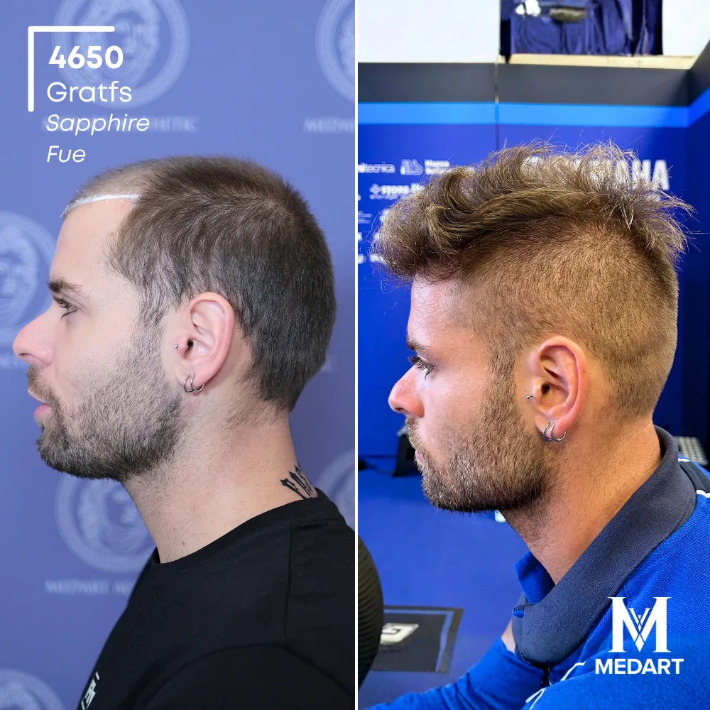 Delbianco Sapphire FUE-haartransplantatie voor-en-na-foto 4, 4650 grafts bij Medart Hair