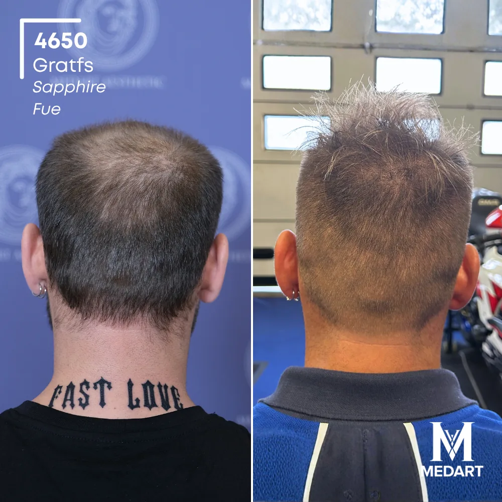Delbianco Sapphire FUE-haartransplantatie voor-en-na-foto 5, 4650 grafts bij Medart Hair