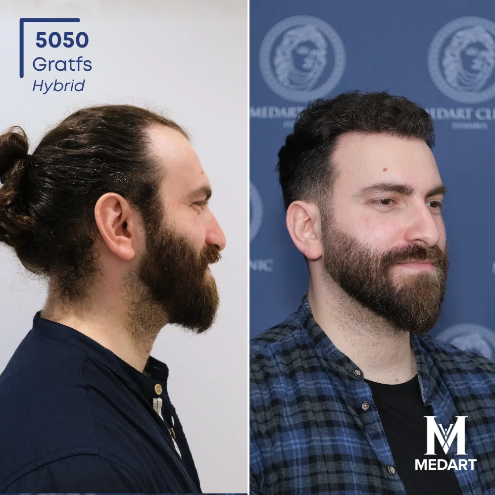 Emirhan Hybride haartransplantatie voor-en-na-foto 3, 5050 grafts bij Medart Hair