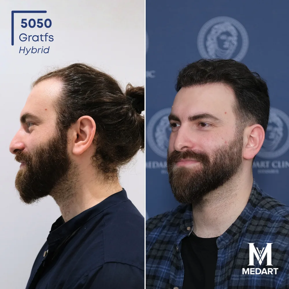 Emirhan Hybride haartransplantatie voor-en-na-foto 4, 5050 grafts bij Medart Hair