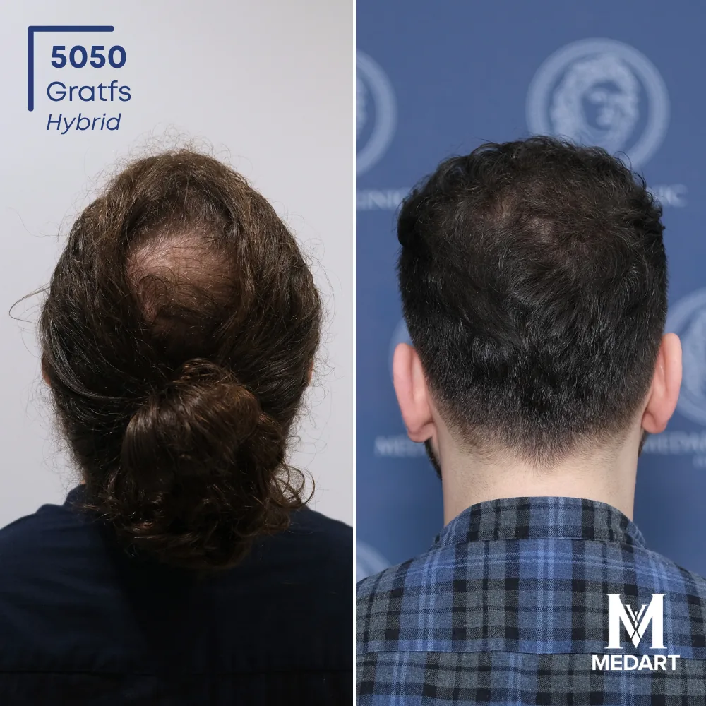 Emirhan Hybride haartransplantatie voor-en-na-foto 5, 5050 grafts bij Medart Hair