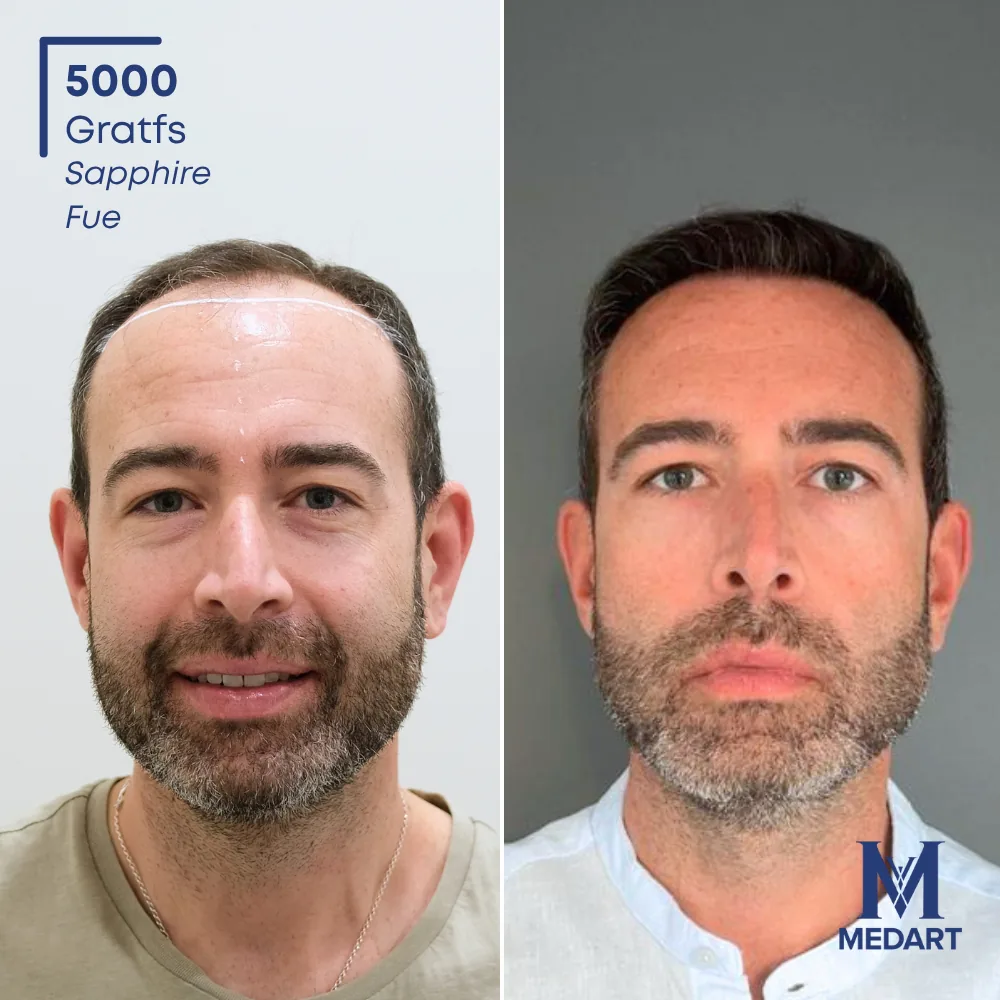 Felice Asta Sapphire FUE-haartransplantatie voor-en-na-foto 1, 5000 grafts bij Medart Hair