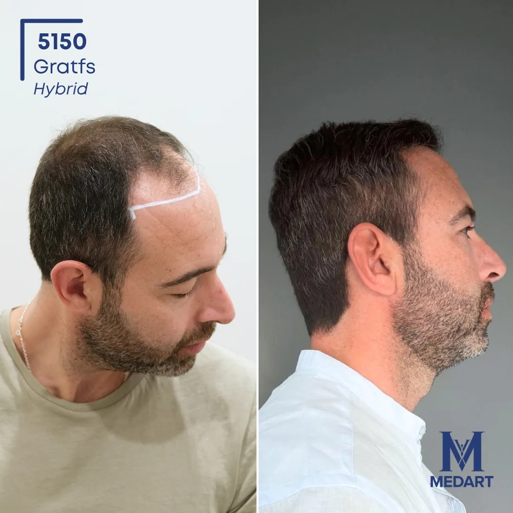 Felice Asta Sapphire FUE-haartransplantatie voor-en-na-foto 4, 5000 grafts bij Medart Hair