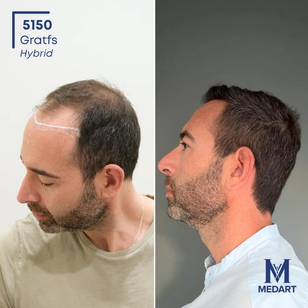 Felice Asta Sapphire FUE-haartransplantatie voor-en-na-foto 5, 5000 grafts bij Medart Hair