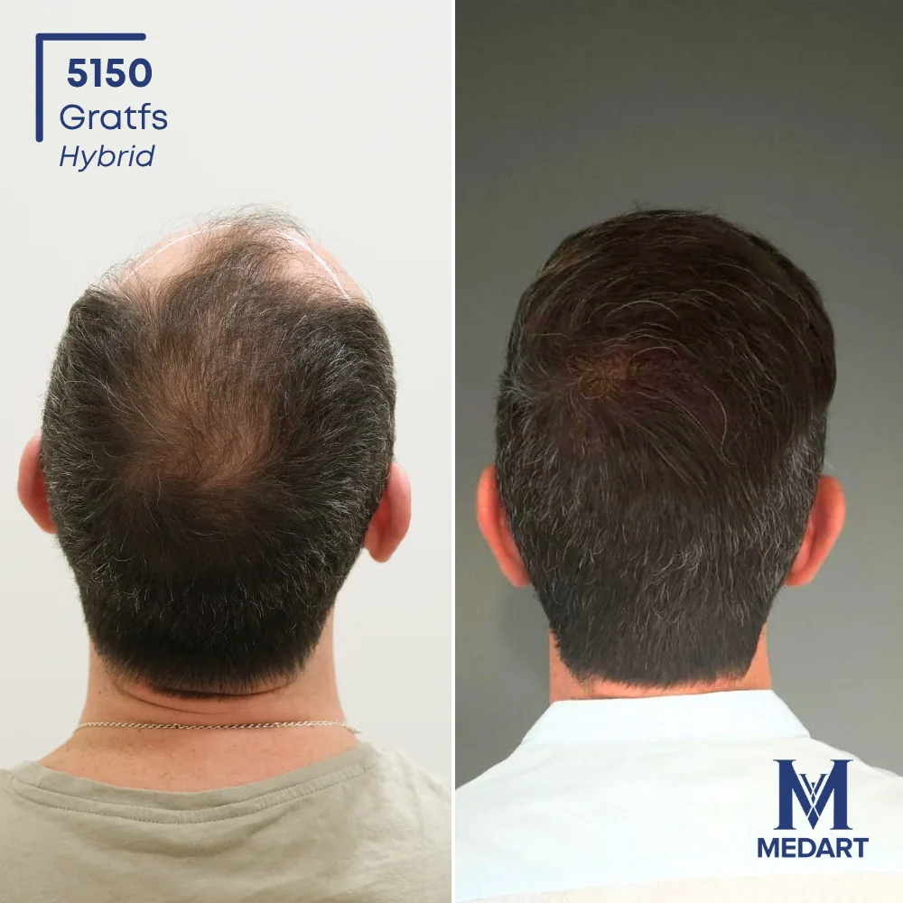 Felice Asta Sapphire FUE-haartransplantatie voor-en-na-foto 3, 5000 grafts bij Medart Hair