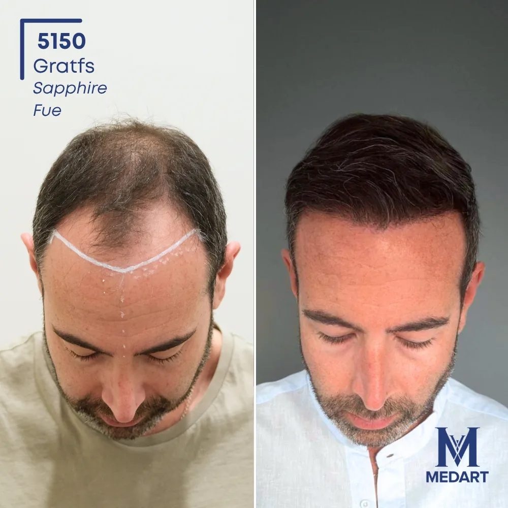 Felice Asta Sapphire FUE-haartransplantatie voor-en-na-foto 2, 5000 grafts bij Medart Hair