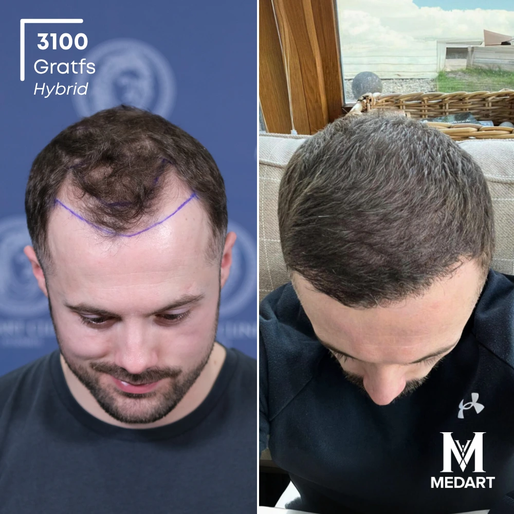 Garin Garland Sapphire FUE-haartransplantatie voor-en-na-foto 2, 3100 grafts bij Medart Hair