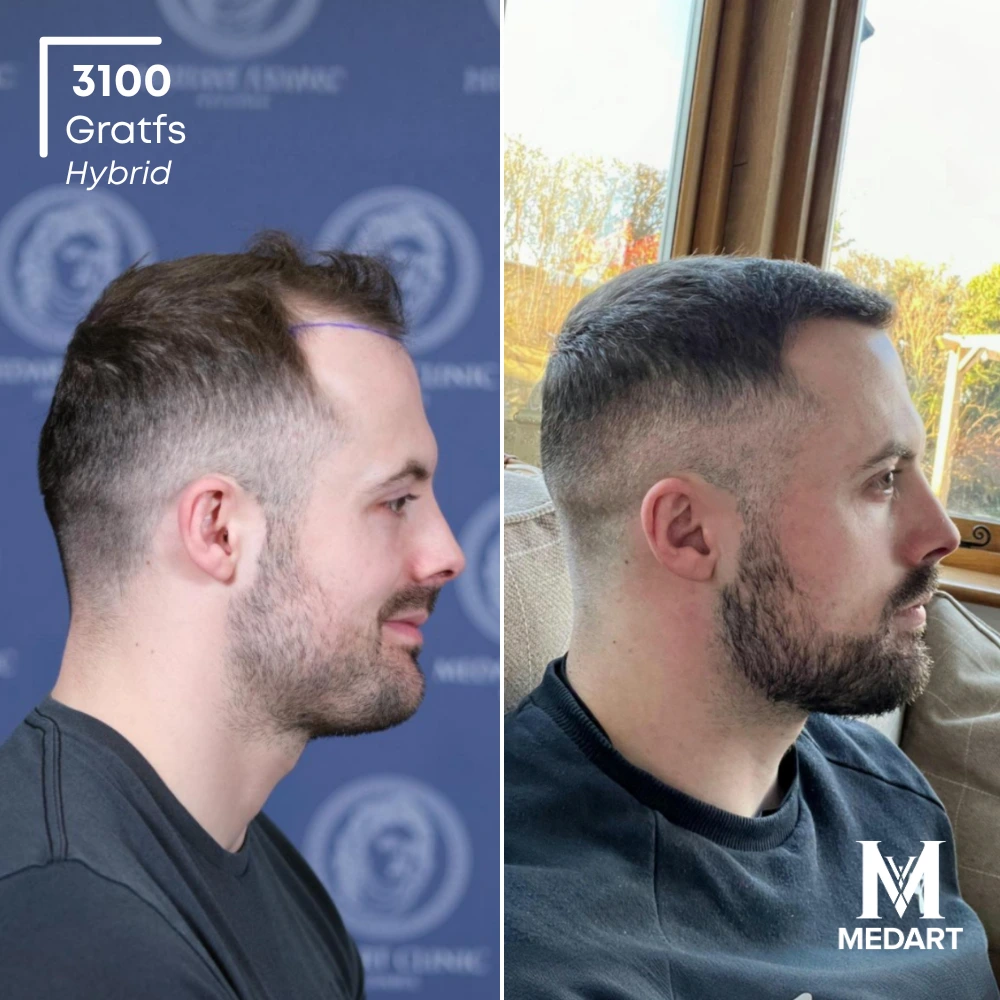 Garin Garland Sapphire FUE-haartransplantatie voor-en-na-foto 3, 3100 grafts bij Medart Hair