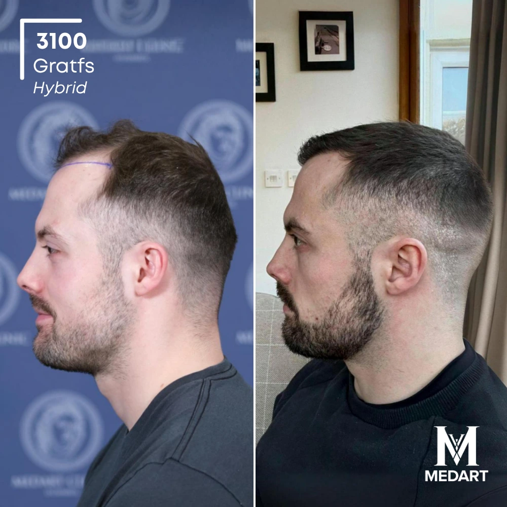 Garin Garland Sapphire FUE-haartransplantatie voor-en-na-foto 4, 3100 grafts bij Medart Hair
