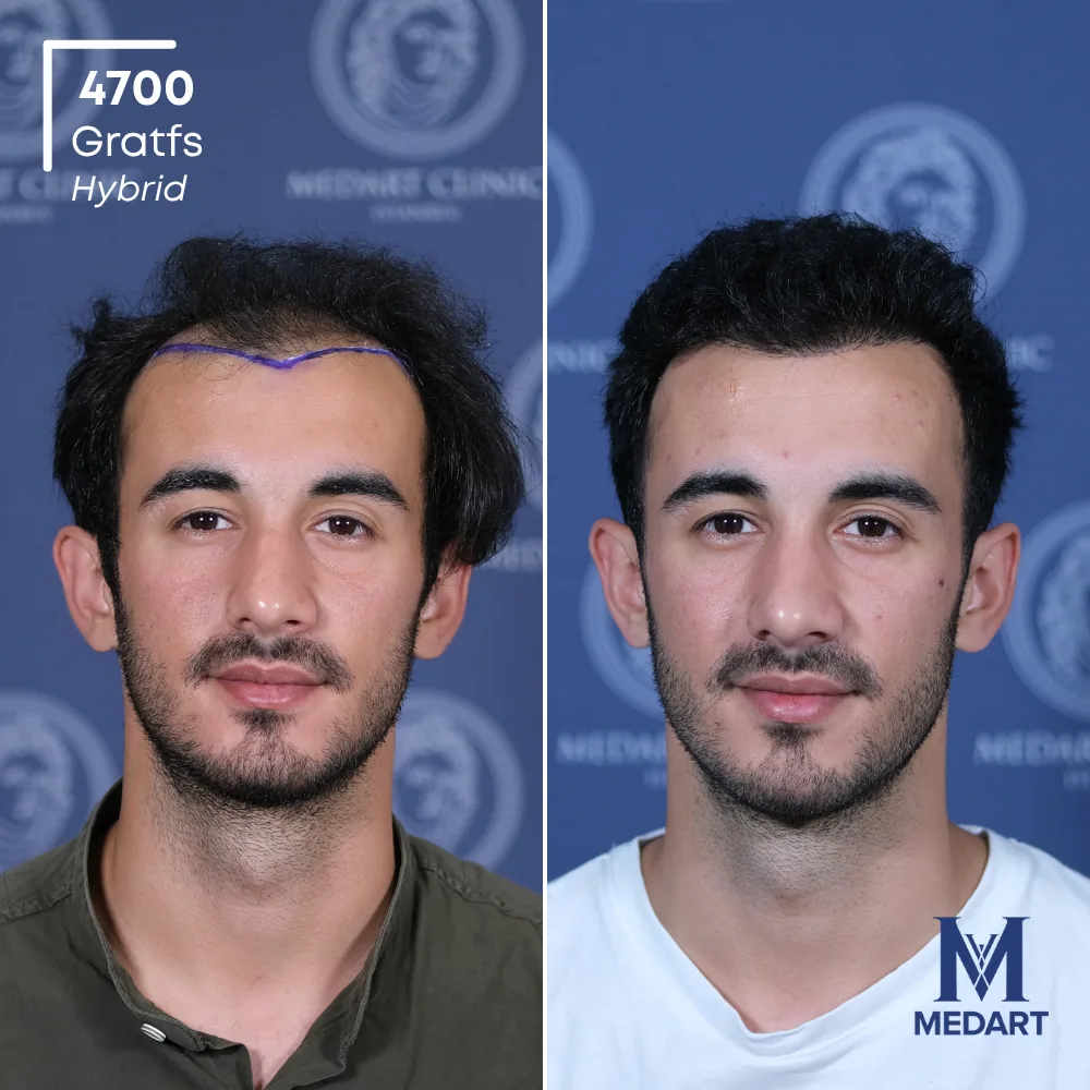 Göktuğ Kağan Hybride haartransplantatie voor-en-na-foto 1, 4700 grafts bij Medart Hair