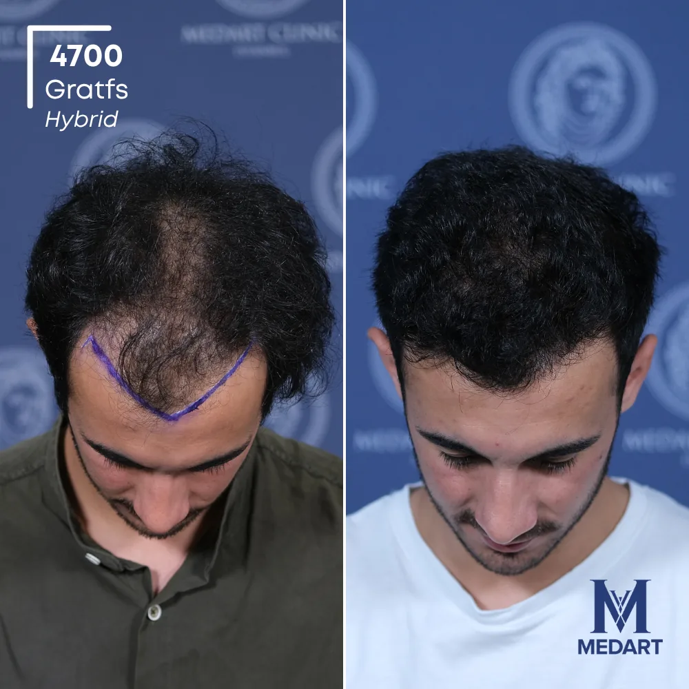 Göktuğ Kağan Hybride haartransplantatie voor-en-na-foto 2, 4700 grafts bij Medart Hair