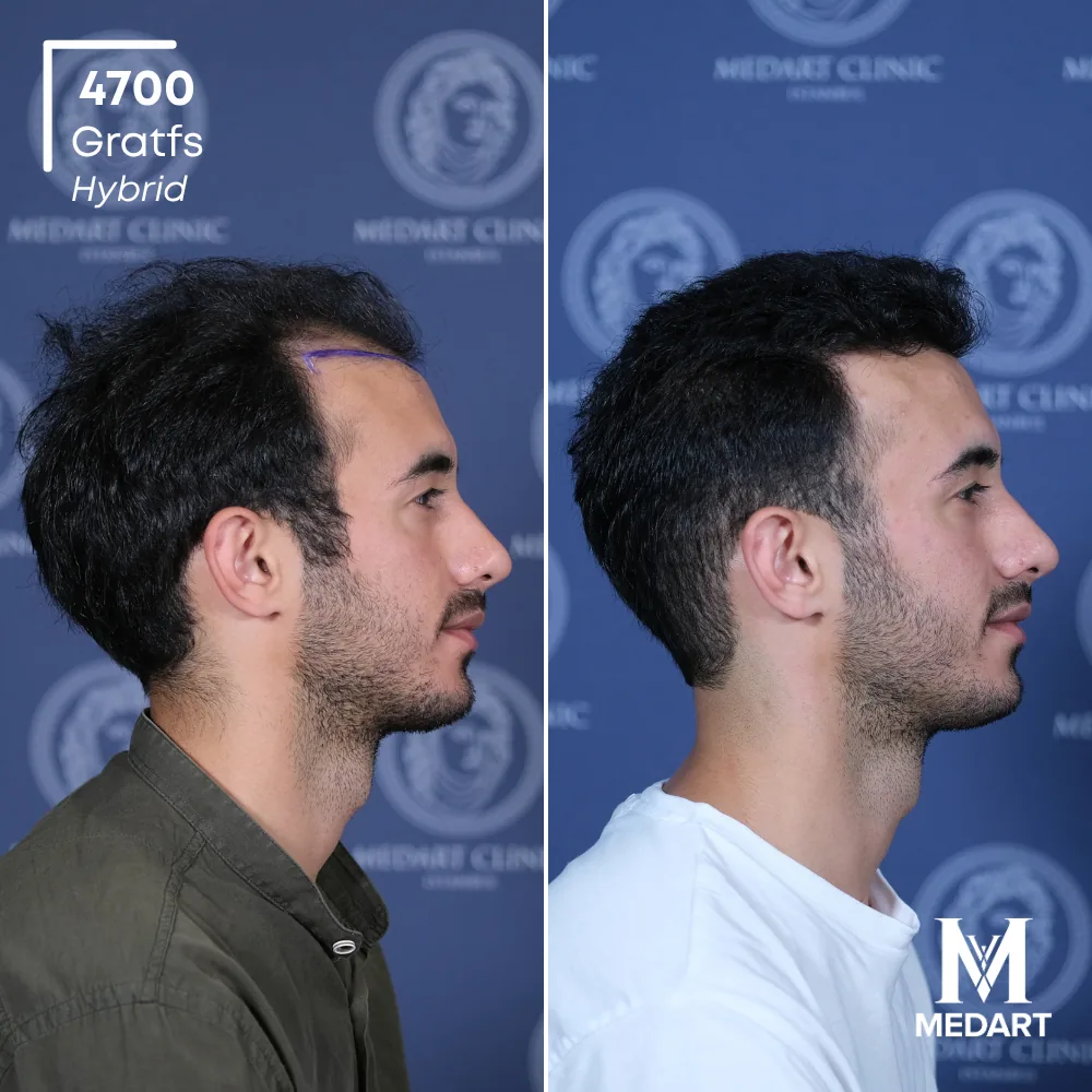 Göktuğ Kağan Hybride haartransplantatie voor-en-na-foto 3, 4700 grafts bij Medart Hair