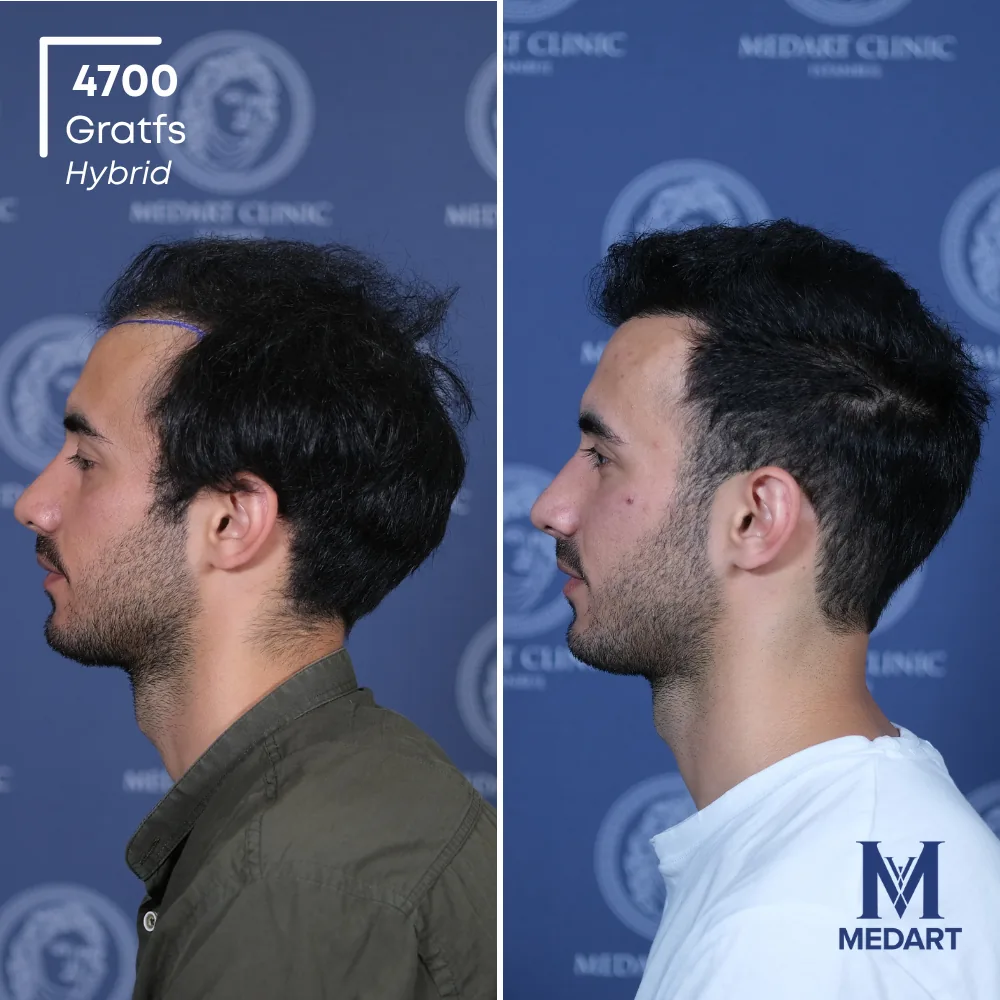 Göktuğ Kağan Hybride haartransplantatie voor-en-na-foto 4, 4700 grafts bij Medart Hair