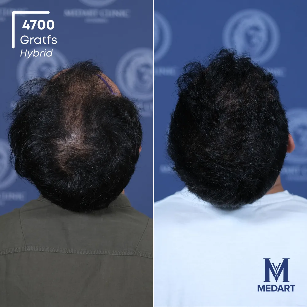 Göktuğ Kağan Hybride haartransplantatie voor-en-na-foto 5, 4700 grafts bij Medart Hair
