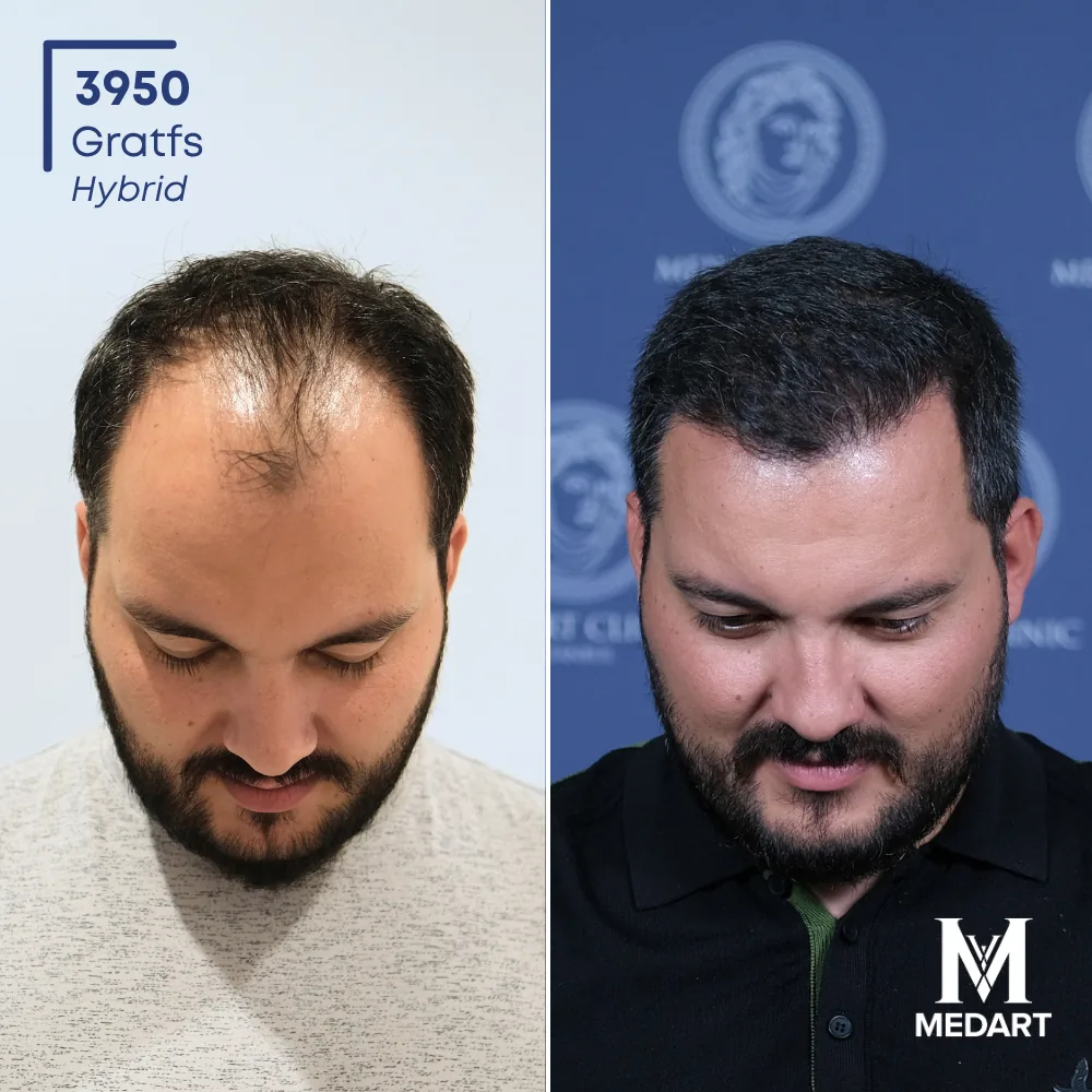 Harun Hybride haartransplantatie voor-en-na-foto 2, 3950 grafts bij Medart Hair