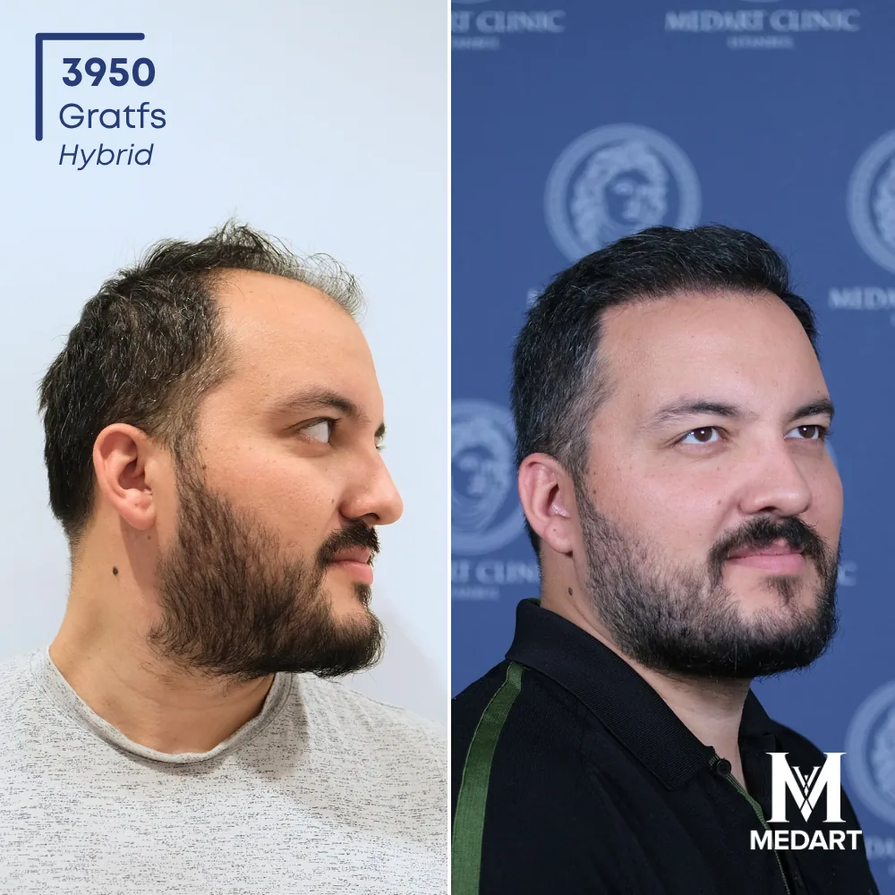 Harun Hybride haartransplantatie voor-en-na-foto 3, 3950 grafts bij Medart Hair