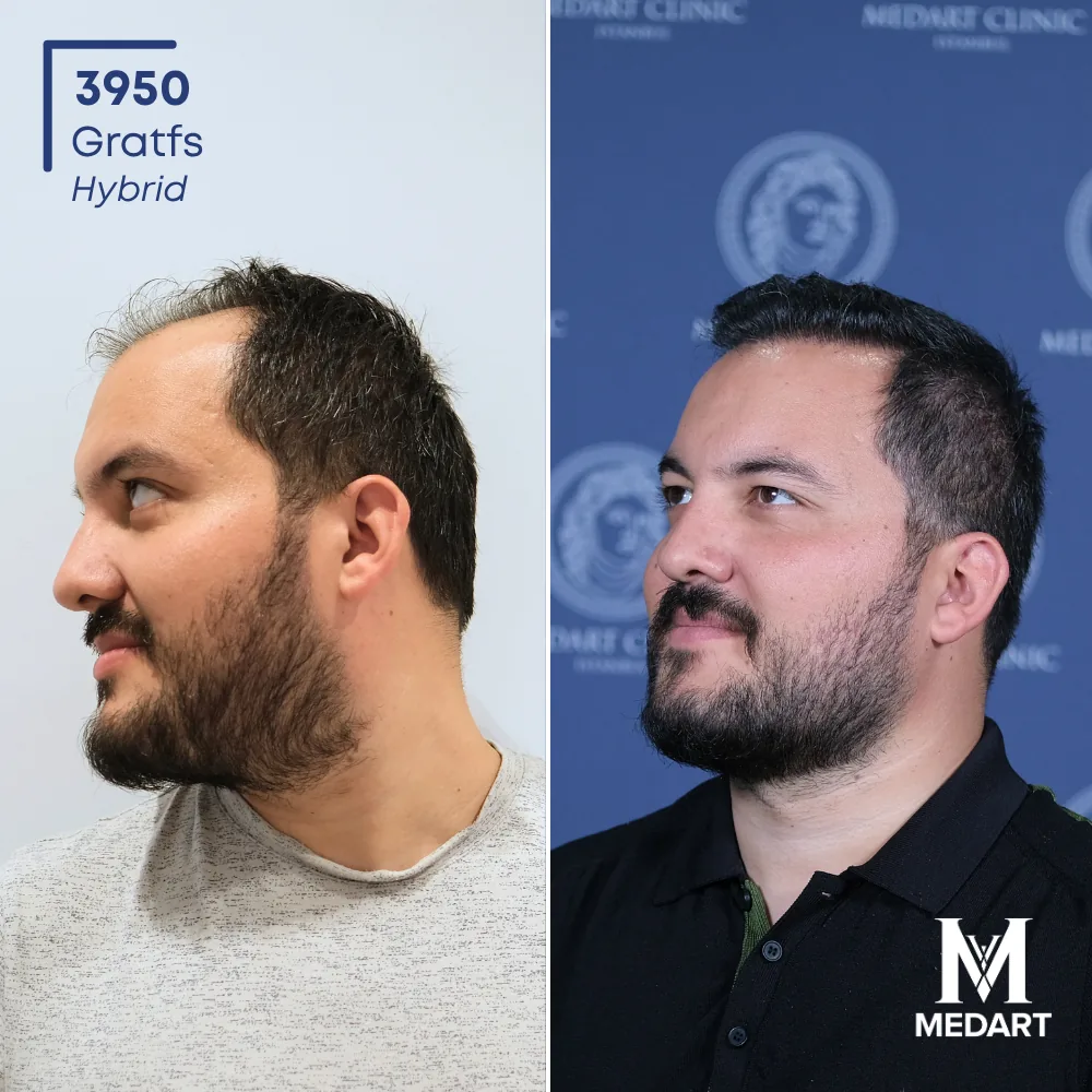 Harun Hybride haartransplantatie voor-en-na-foto 4, 3950 grafts bij Medart Hair