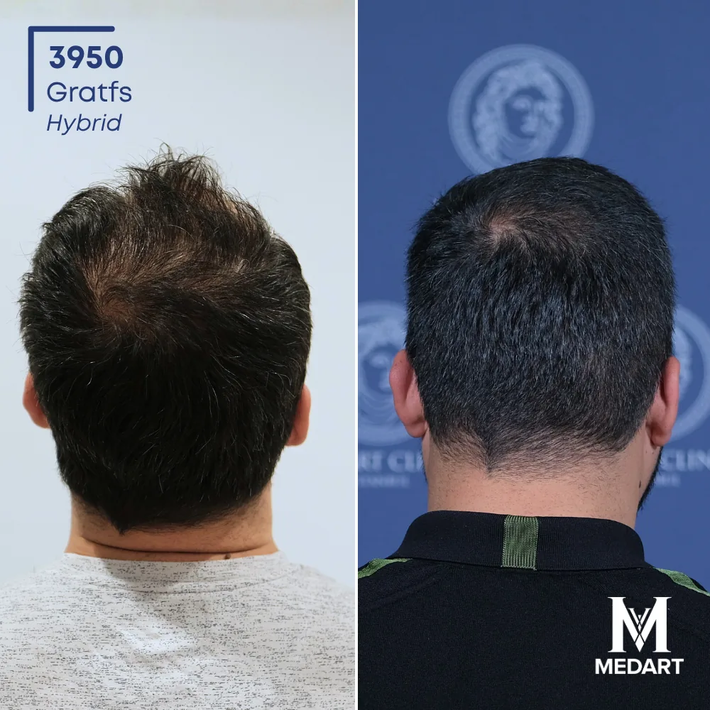 Harun Hybride haartransplantatie voor-en-na-foto 5, 3950 grafts bij Medart Hair