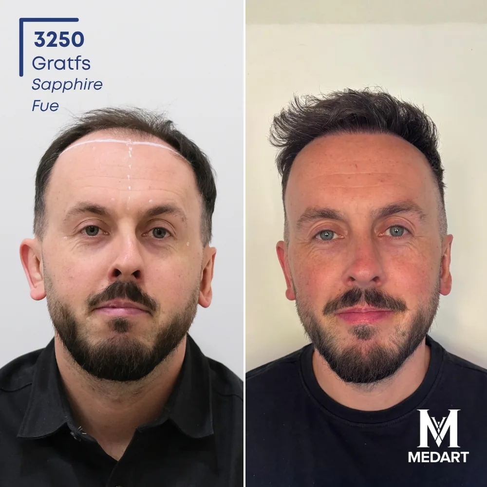 Jack Cresswell Sapphire FUE-haartransplantatie voor-en-na-foto 1, 3250 grafts bij Medart Hair