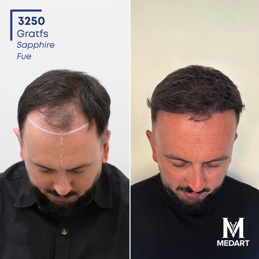 Jack Cresswell Sapphire FUE-haartransplantatie voor-en-na-foto 2, 3250 grafts bij Medart Hair