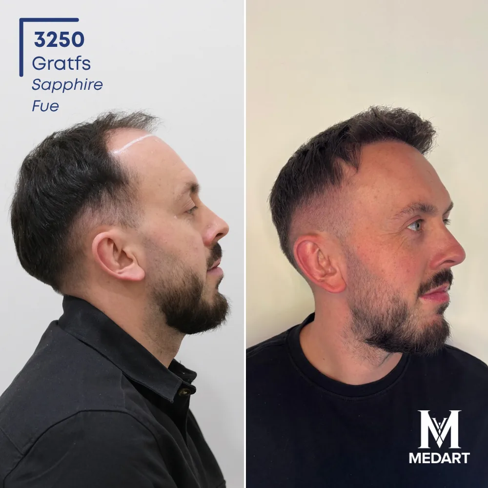 Jack Cresswell Sapphire FUE-haartransplantatie voor-en-na-foto 3, 3250 grafts bij Medart Hair