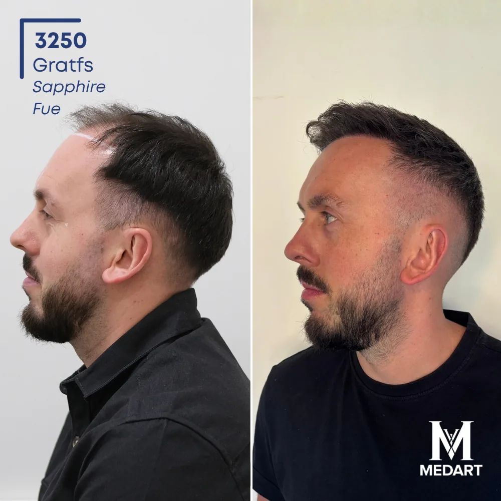 Jack Cresswell Sapphire FUE-haartransplantatie voor-en-na-foto 4, 3250 grafts bij Medart Hair
