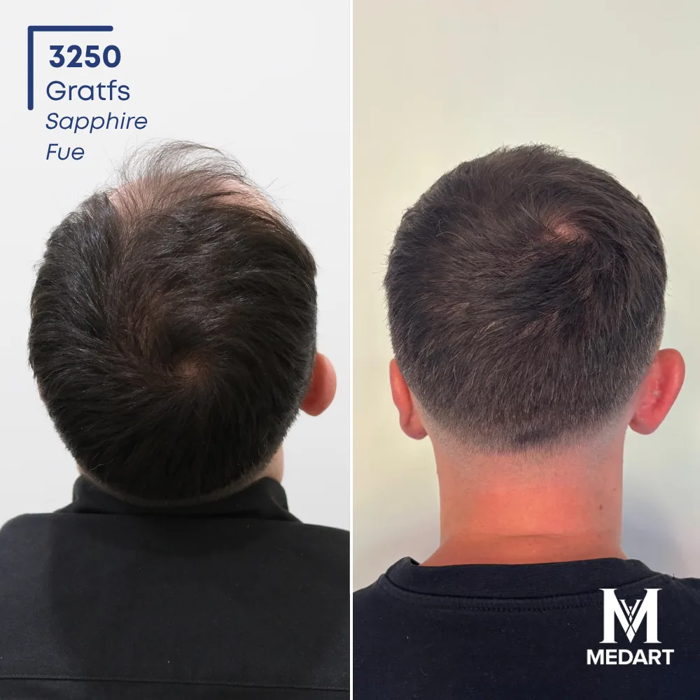 Jack Cresswell Sapphire FUE-haartransplantatie voor-en-na-foto 5, 3250 grafts bij Medart Hair