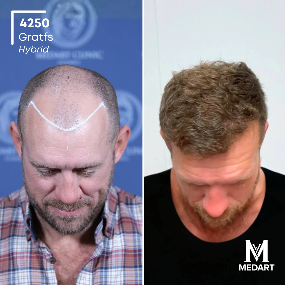 Jacop Kieran Hybride haartransplantatie voor-en-na-foto 2, 4250 grafts bij Medart Hair